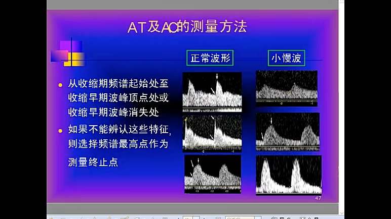 【超声网课】肾动脉狭窄的超声诊断哔哩哔哩bilibili