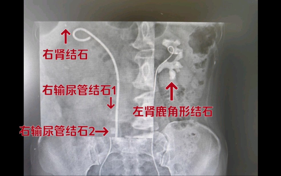 肾结石输尿管结石的CT及KUB阅片哔哩哔哩bilibili