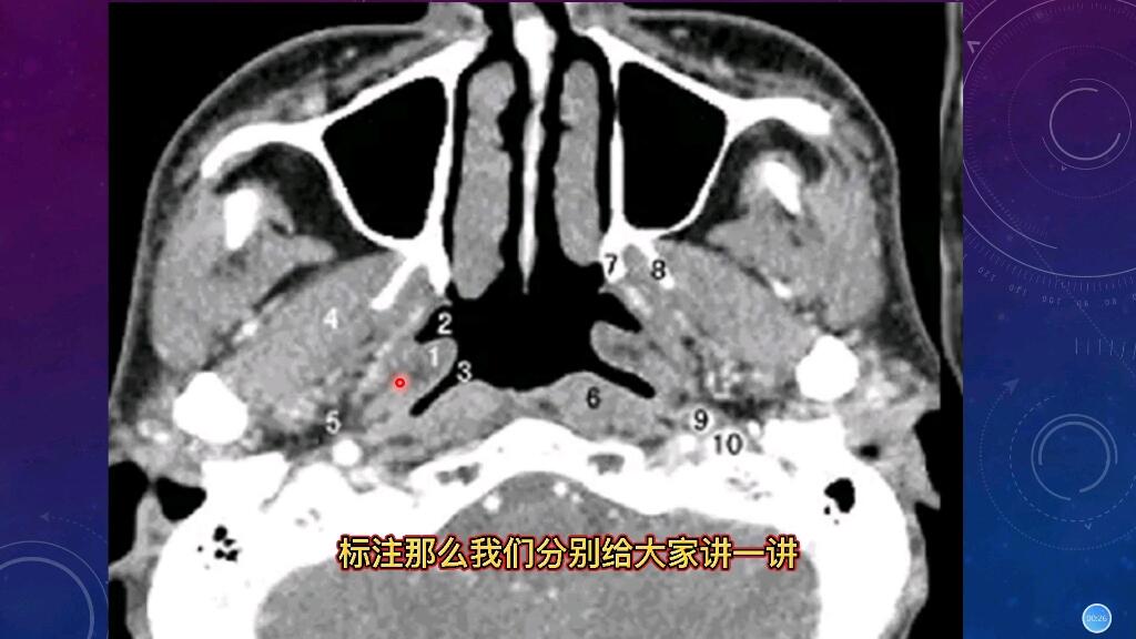 鼻咽部正常CT解剖结构讲解,专科医生分享,3分钟记住 - 哔哩哔哩