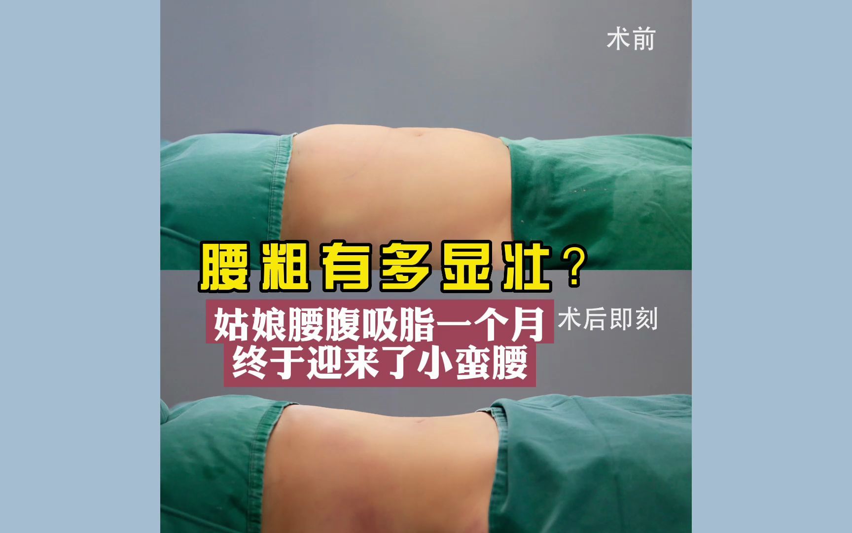 [图]腰粗有多显壮？ 姑娘腰腹吸脂一个月 终于迎来了小蛮腰