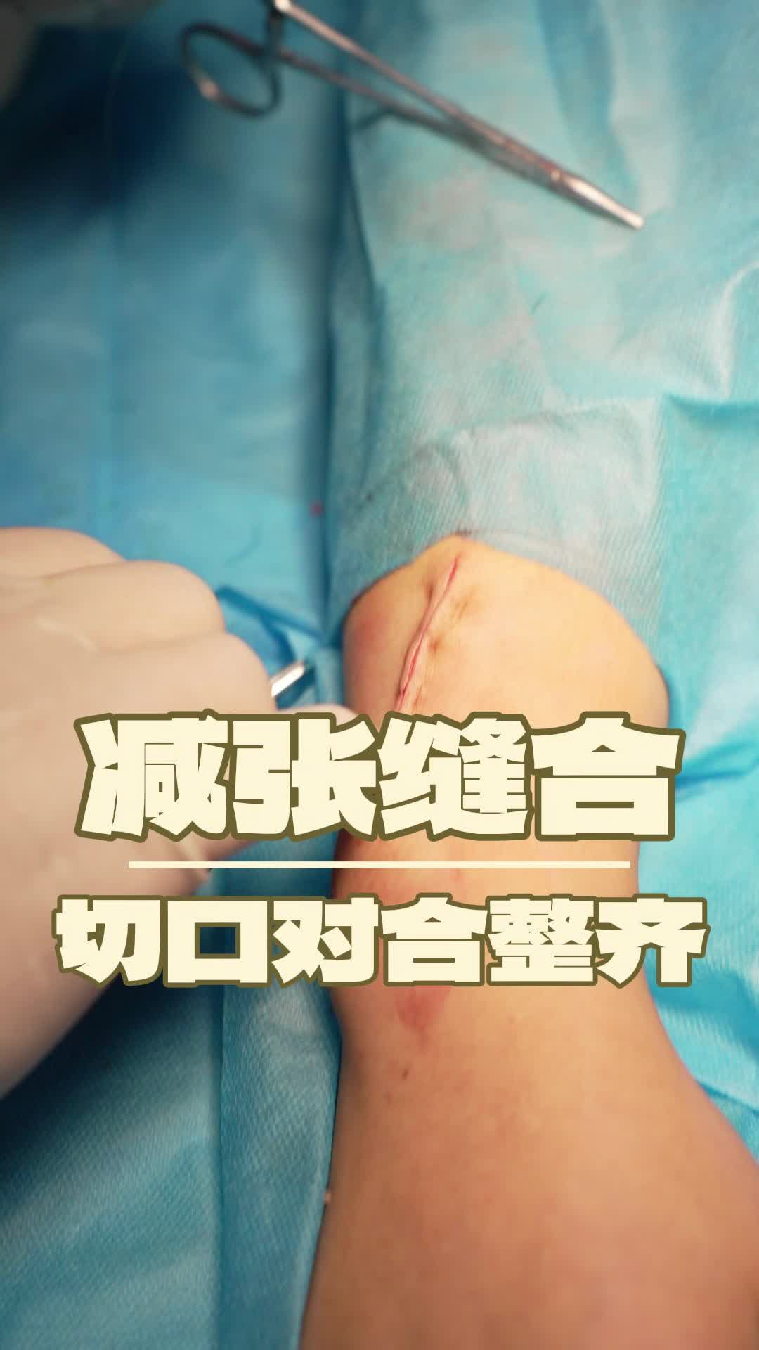 超减张缝合隆起长平了图片