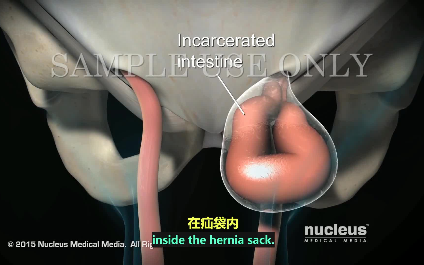 [图]【3D医学动画】疝气（中英双字幕+原版英文）