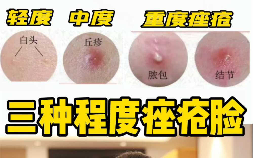 [图]如何治疗痘痘痤疮❓十年痤疮脸?泪经验分享