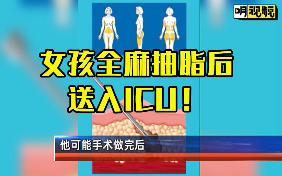 女孩去医美机构抽脂后被送入ICU,全麻手术需要注意什么?医美乱象何日停?哔哩哔哩bilibili