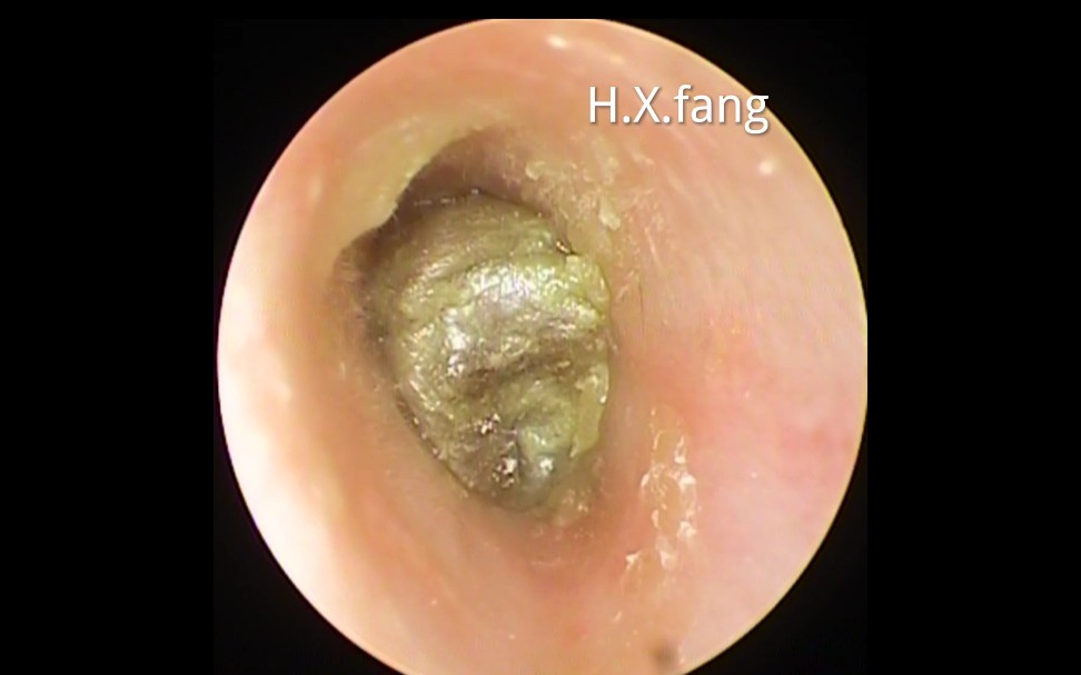 专业可视采耳-耳垢和死皮清除ear wax removal-dead skin cleaning