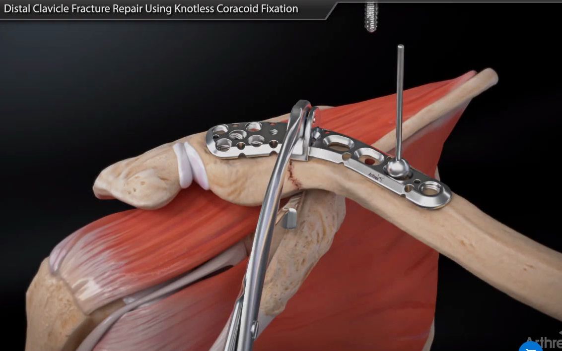 带袢钛板应用案例——Distal Clavicle Fracture Repair Using Coracoid Fixation哔哩哔哩bilibili