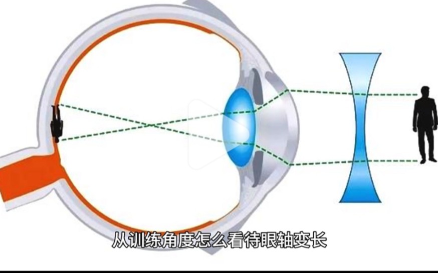 眼轴是怎么变长的?近视到底可不可逆?哔哩哔哩bilibili