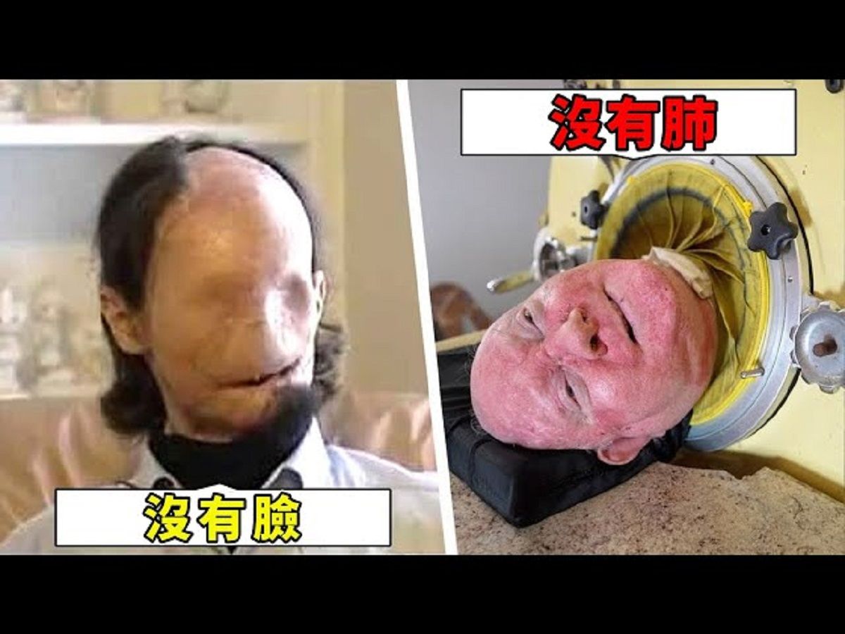 [图]世界上最堅強的10個奇人，沒有心臟也能存活，缺失生殖器也能傳宗接代？#驚奇時刻 #top10 #腦洞大開 #世界奇聞