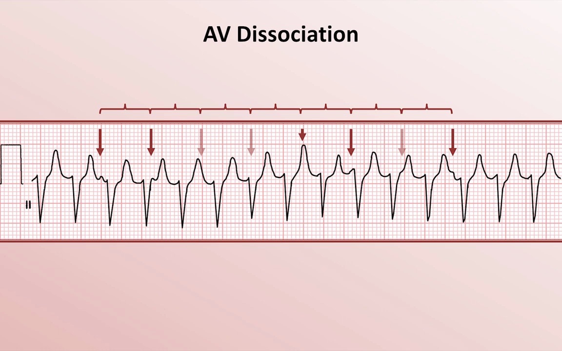 Distinguishing VT from SVT with aberrancy 区分VT与SVT的反常性哔哩哔哩bilibili