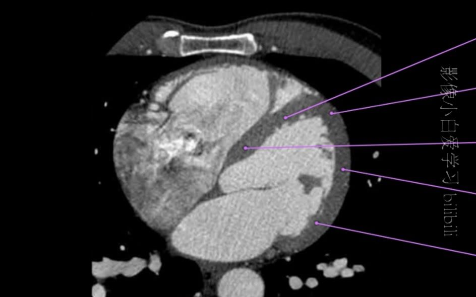心肌纵断面图片
