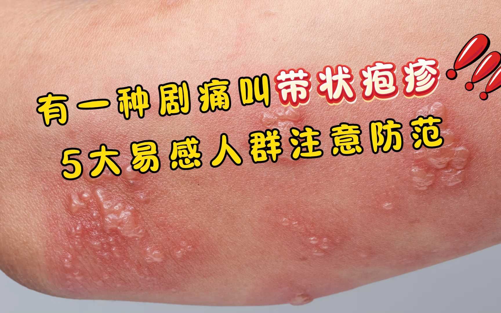 有一种剧痛叫“带状疱疹”!提醒:5大易感人群,注意提前防范哔哩哔哩bilibili