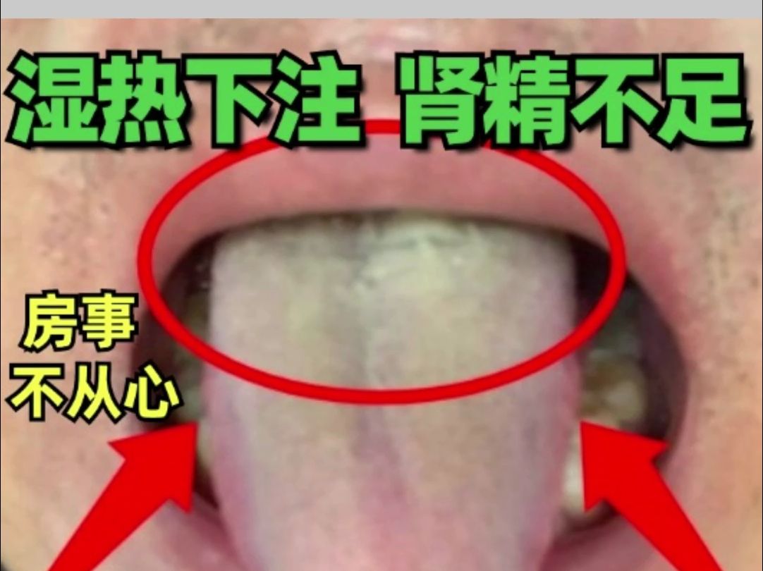 湿气重,肾精不足,肝郁脾虚的三种典型舌象!