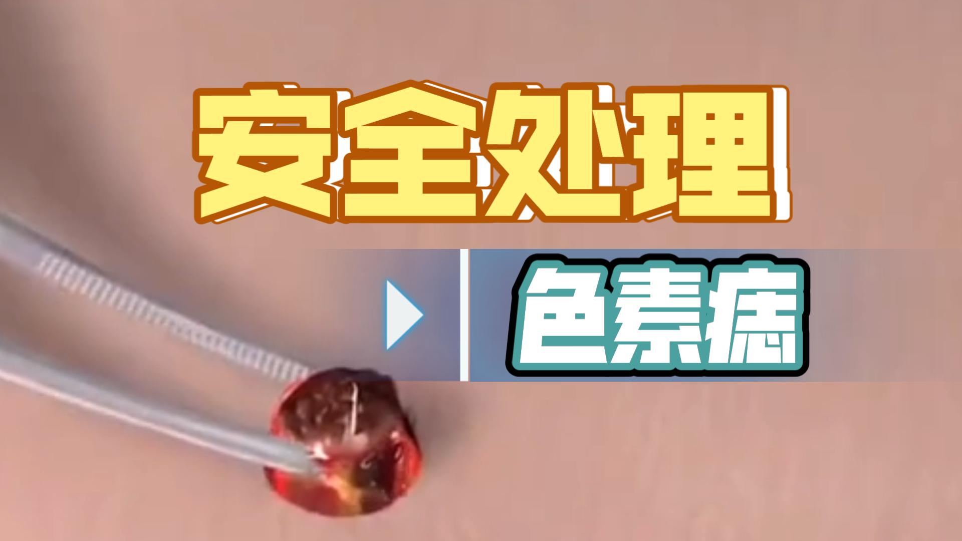 色素痣切除的过程,祛痣手术哔哩哔哩bilibili