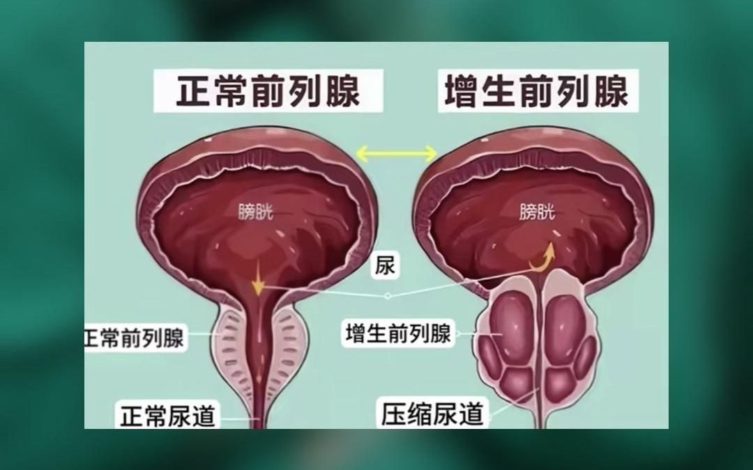 前列腺增生和正常人,有什么区别呢