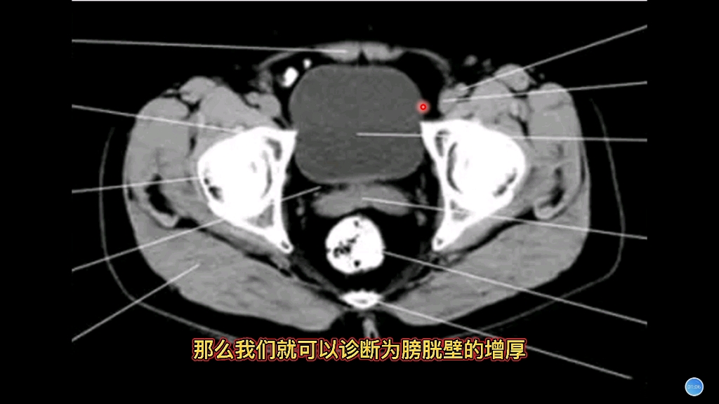 正常膀胱前列腺在ct上什么表现放射科医生分享解剖