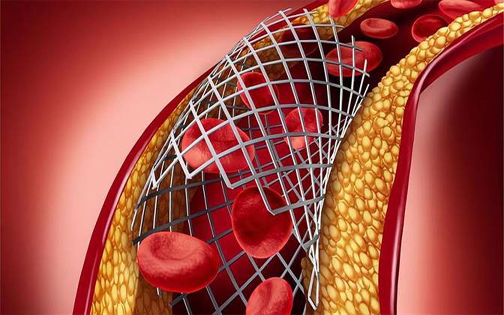 心脏支架是如何工作的 植入内部将血管撑开,3d动画演示全过程1