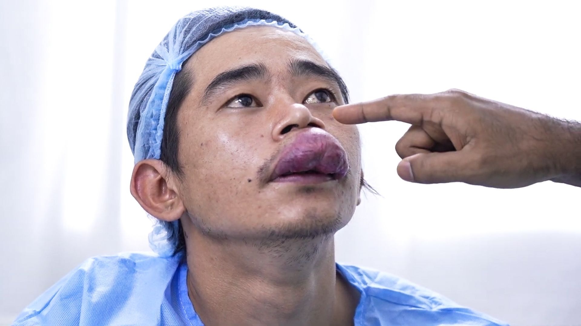 小伙每天亲嘴,导致嘴巴肿起一个大肉球