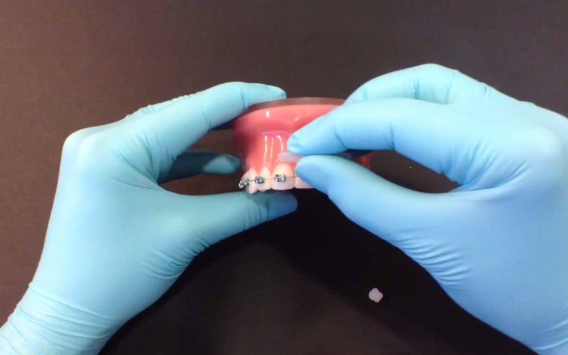 怎样使用正畸保护蜡