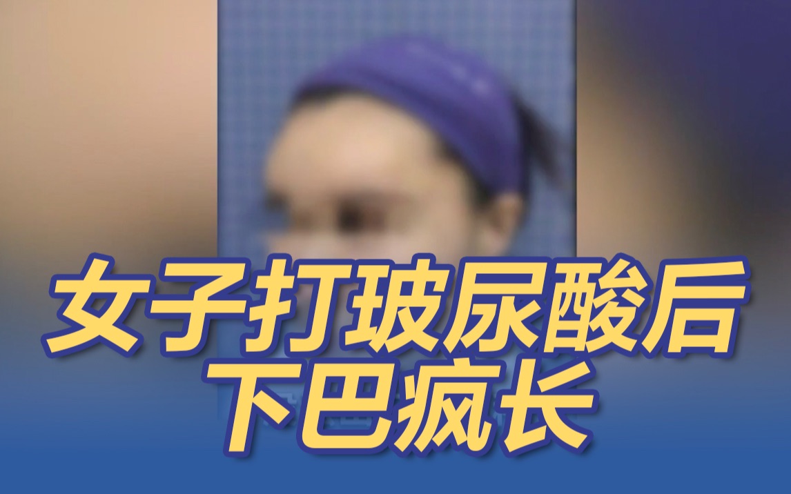 北京一女子打玻尿酸后下巴疯狂生长 又长又歪哔哩哔哩bilibili