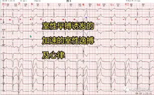 Download Video: 室性早搏诱发的加速的室性逸搏及心律