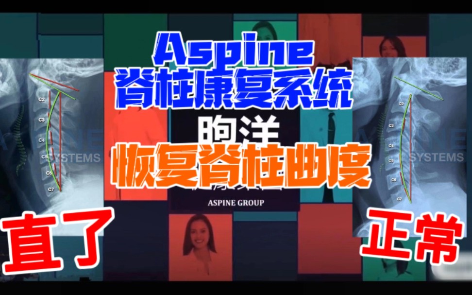 Aspine脊柱康复系统恢复脊柱生理曲度哔哩哔哩bilibili