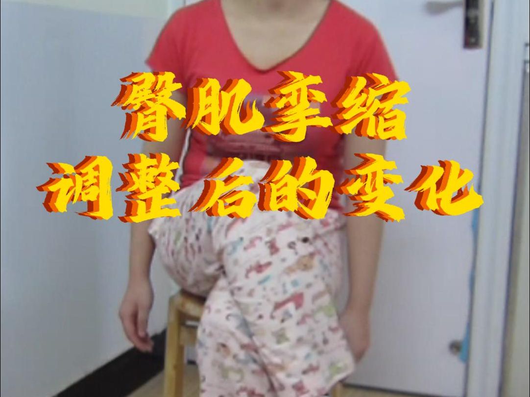 蜕变之旅:臀肌挛缩调整效果大公开