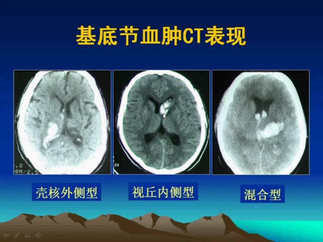 2023最新版 CT阅片诊断教学视频 老师精讲完整版哔哩哔哩bilibili