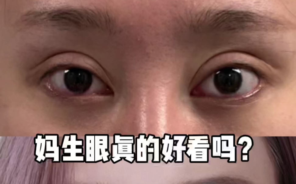 听我一句劝!双眼皮宁窄勿宽,悲伤蛙的眼睛这次能逆袭上岸吗?