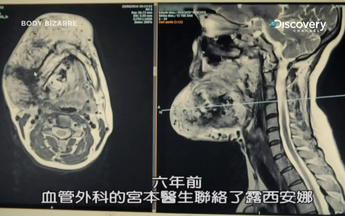 身体上60多公斤的肿瘤人体不思议 第5季第2集JLPCN.NET奥视纪录片天地哔哩哔哩bilibili