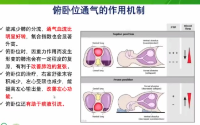 重症医学中 俯卧位通气站位与操作哔哩哔哩bilibili