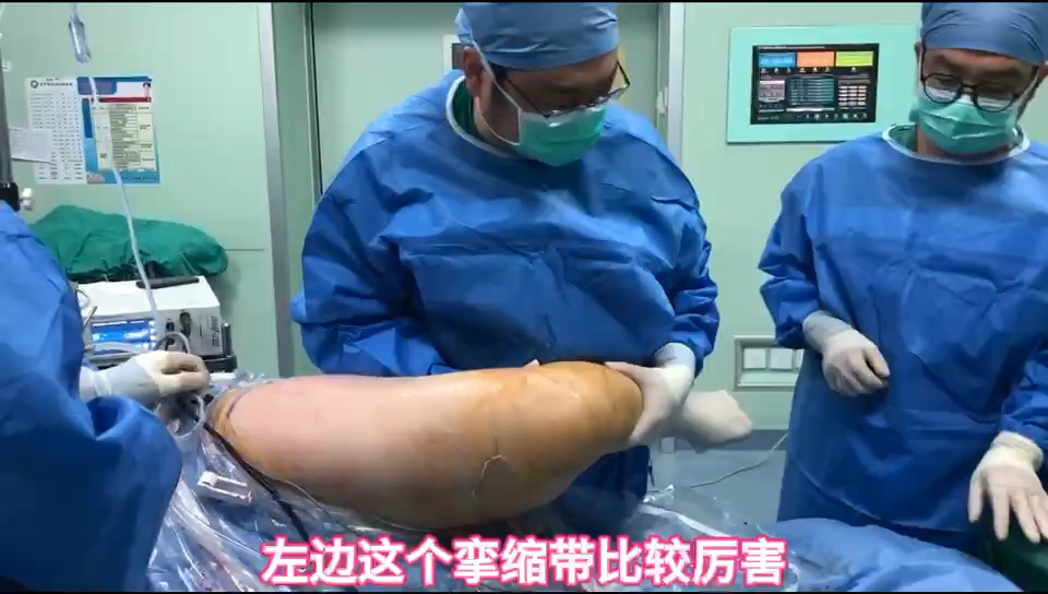 双侧臀肌挛缩系列(八)精致手术倡导者(五十七)