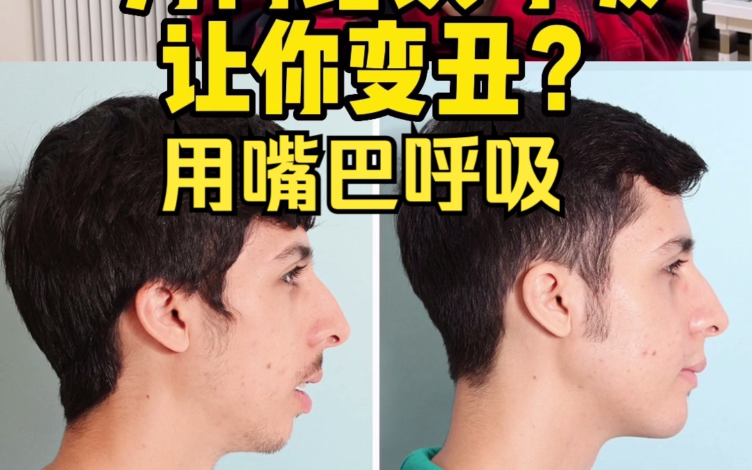 用嘴巴呼吸,长期会让人变丑!
