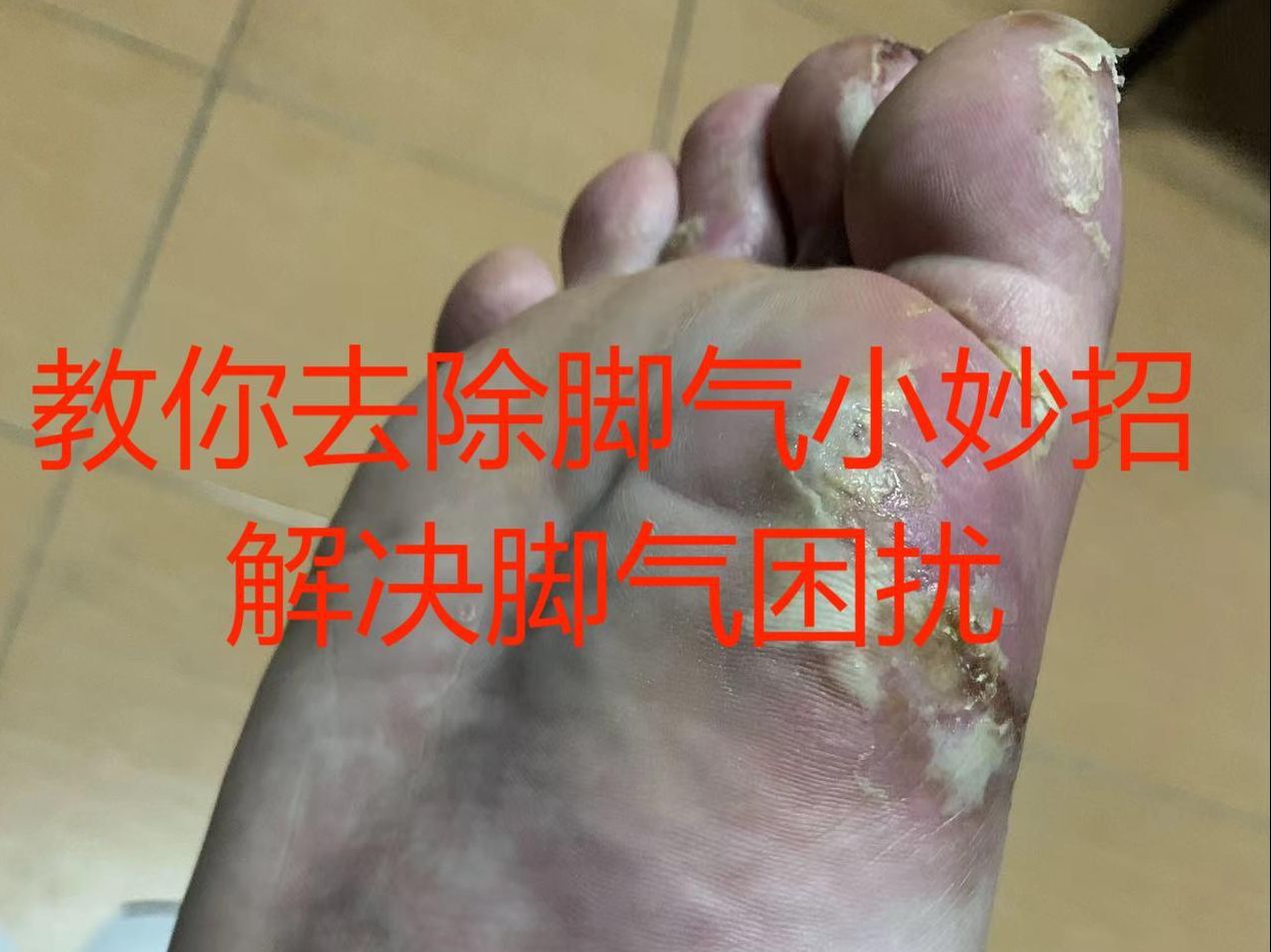 嘗試各種辦法都解決不了的腳底脫皮潰爛問題,用一招就被去除了