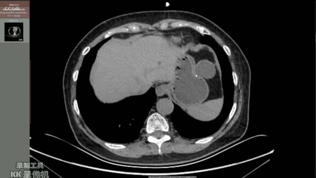 ct三维重建 肝囊肿