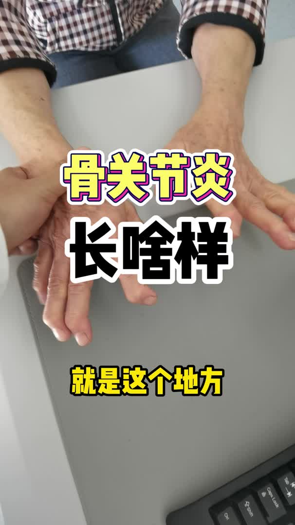 骨关节炎 长啥样?哔哩哔哩bilibili