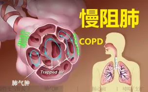 Скачать видео: 【病理三分钟】慢阻肺：慢支/肺气肿/肺心病/哮喘/支扩，你分清楚了吗？  （COPD,慢性阻塞性肺气肿）