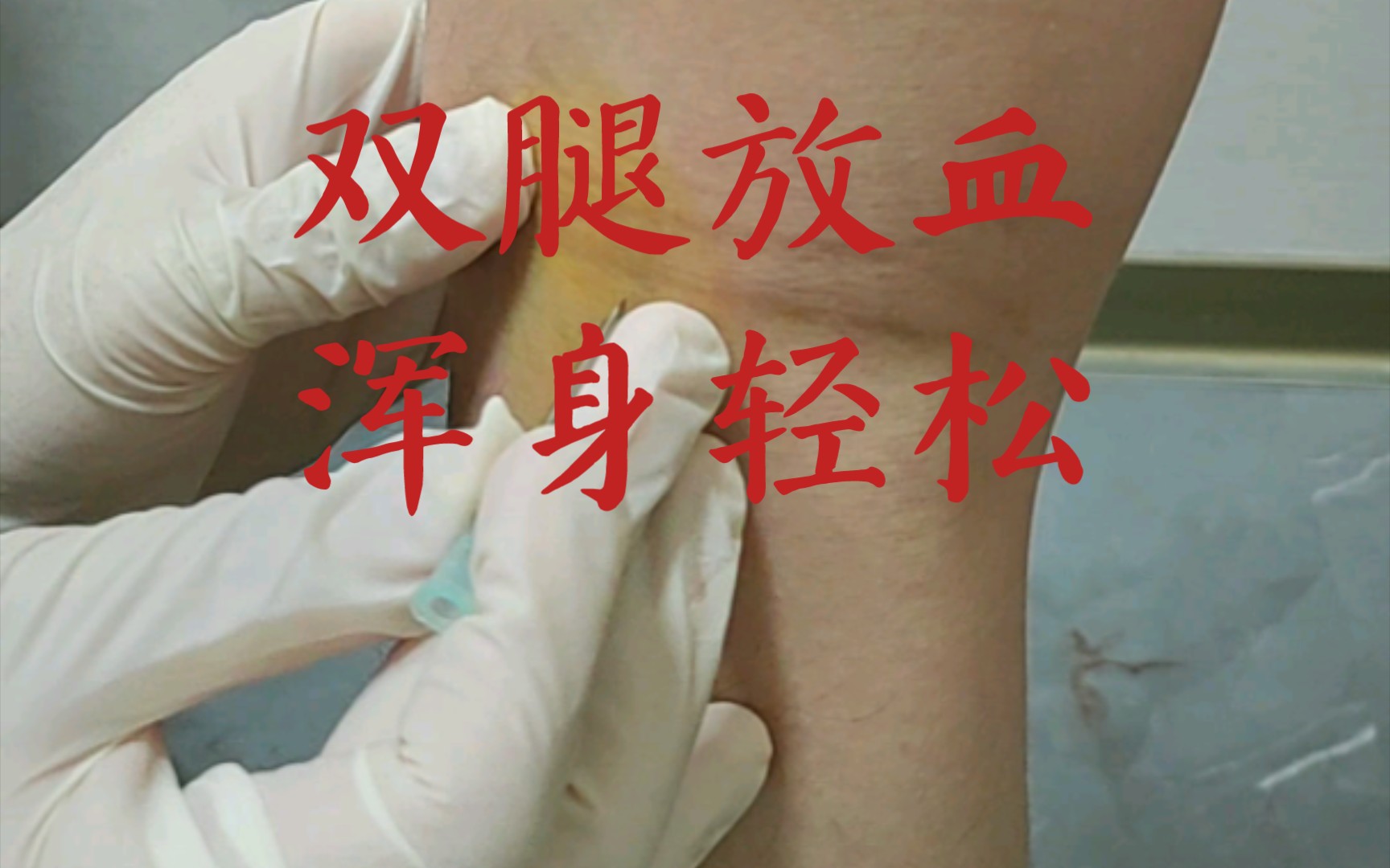 委中委阳刺血,效果明显.-西游小鱼哥-默认收藏夹-哔哩哔哩视频