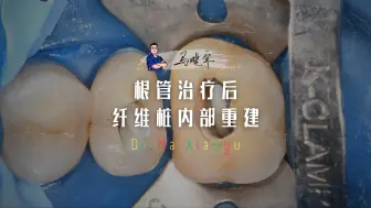 Download Video: 根管治疗后采用纤维桩&高填料流体树脂完成内部重建