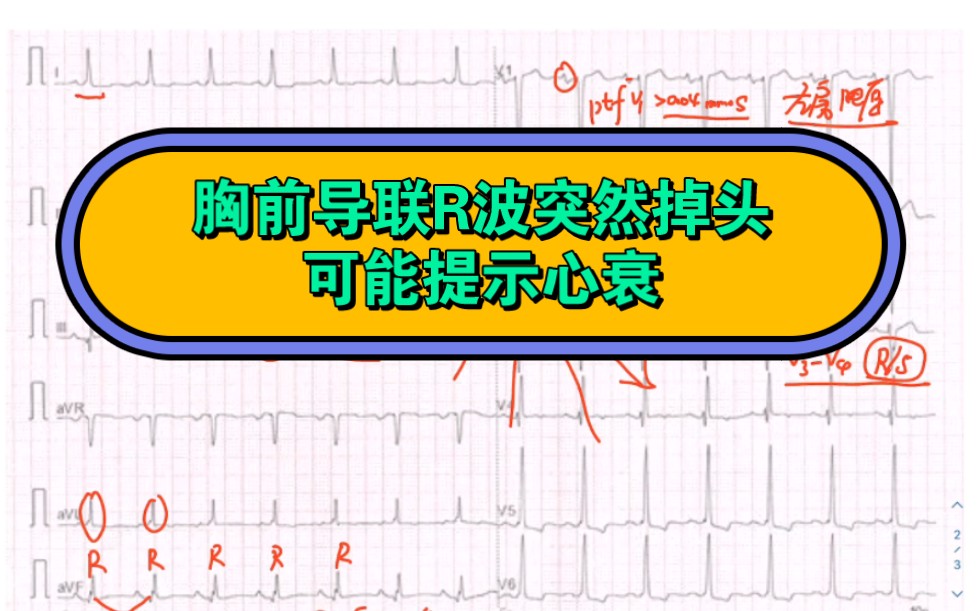 窦性心律,左房异常,左室高电压,V1V3 R波递增不良,略顺钟位转向,V4R波掉头,stt改变,哔哩哔哩bilibili