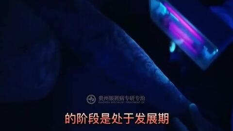 贵州银屑病治疗