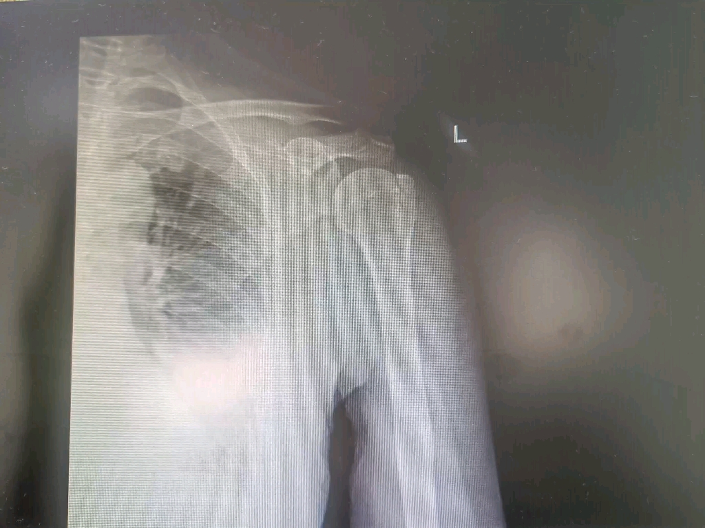 跟我一起刷ct:肱骨大结节骨折