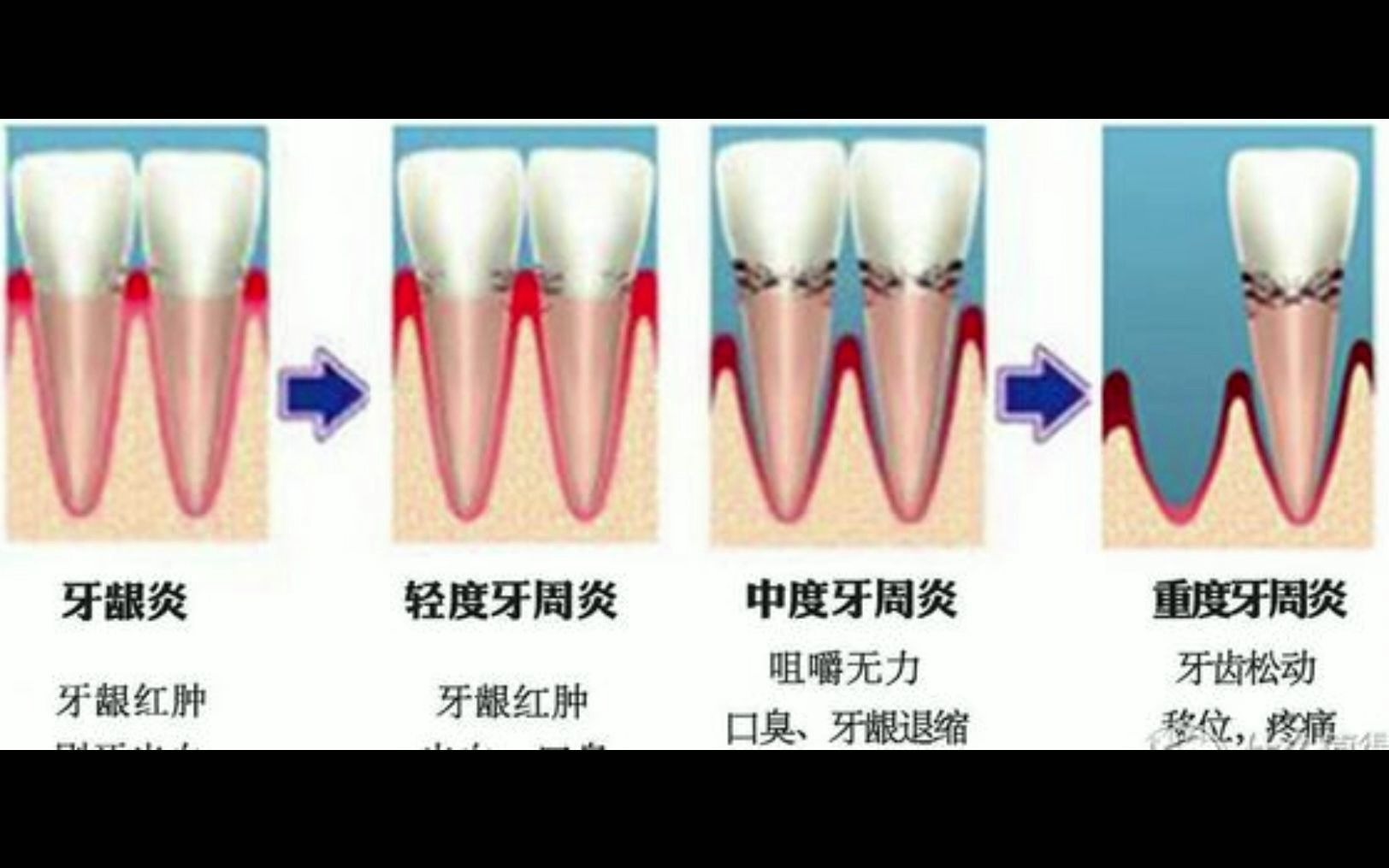 牙周炎能用电动牙刷吗?牙周炎人群如何选购电动牙刷?哔哩哔哩bilibili