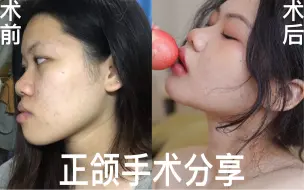 我做了Angelababy同款手术！正颌手术经历分享