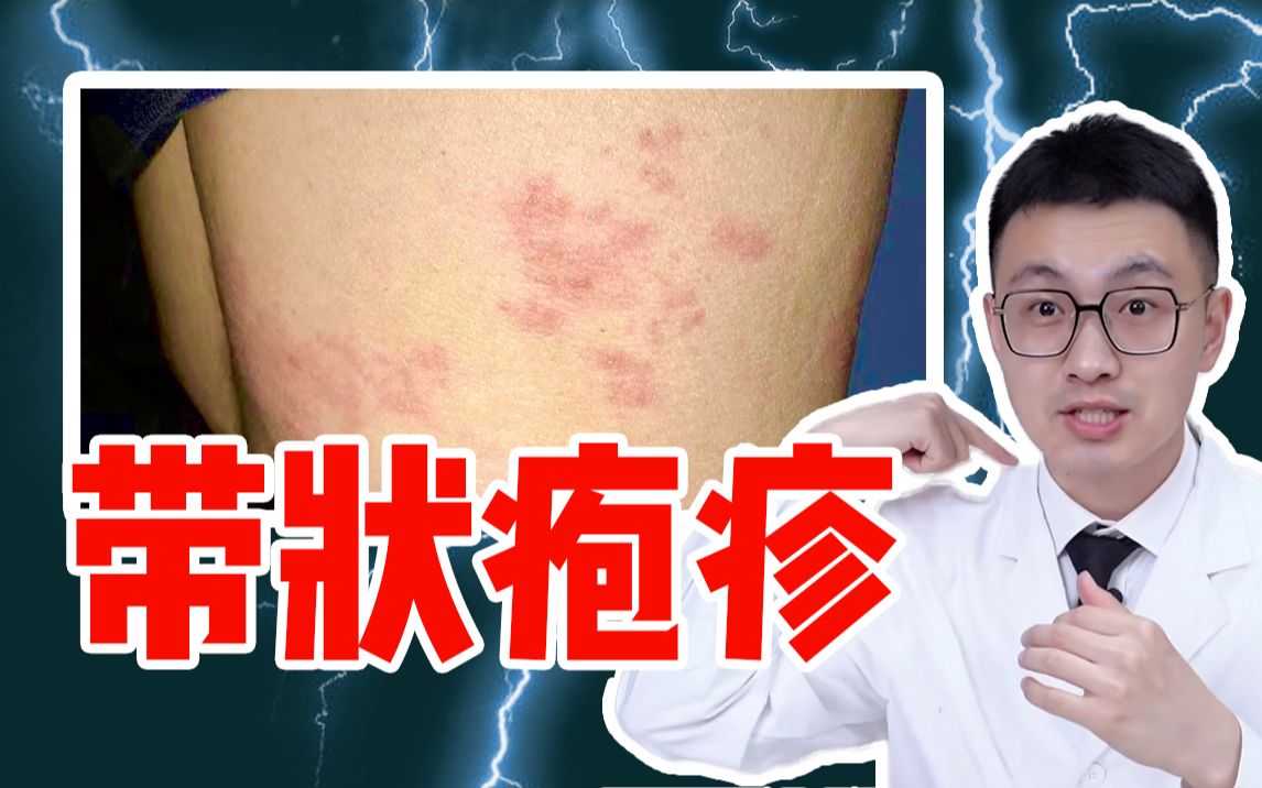 [图]痛过生孩子？缠腰一圈会死人？【带状疱疹】好治吗？