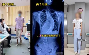 Video herunterladen: 13岁女生长到一米八，到医院检查后医生不淡定了：赶紧进行手术！