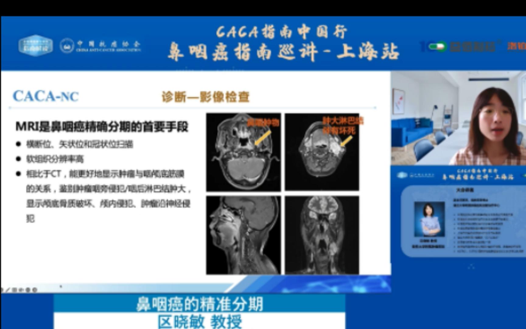 鼻咽癌的精准分期区晓敏 (复旦大学附属肿瘤医院)哔哩哔哩bilibili