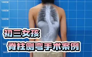 Descargar video: 初三女孩脊柱侧弯案例分享，术后腰困问题解决，长高了人也更自信了