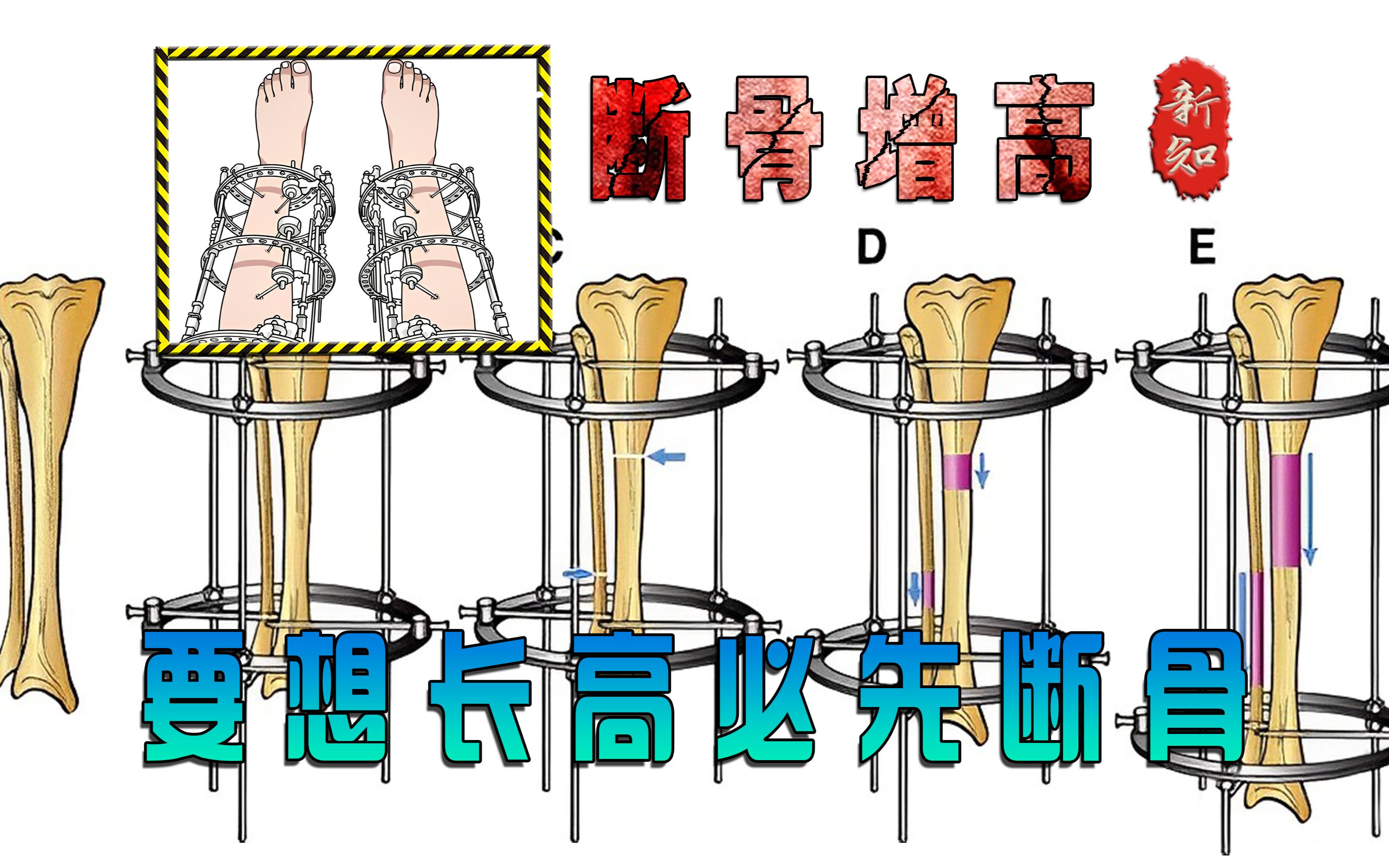 想要长高必先断骨的增高方式.断骨增高究竟有多可怕?哔哩哔哩bilibili