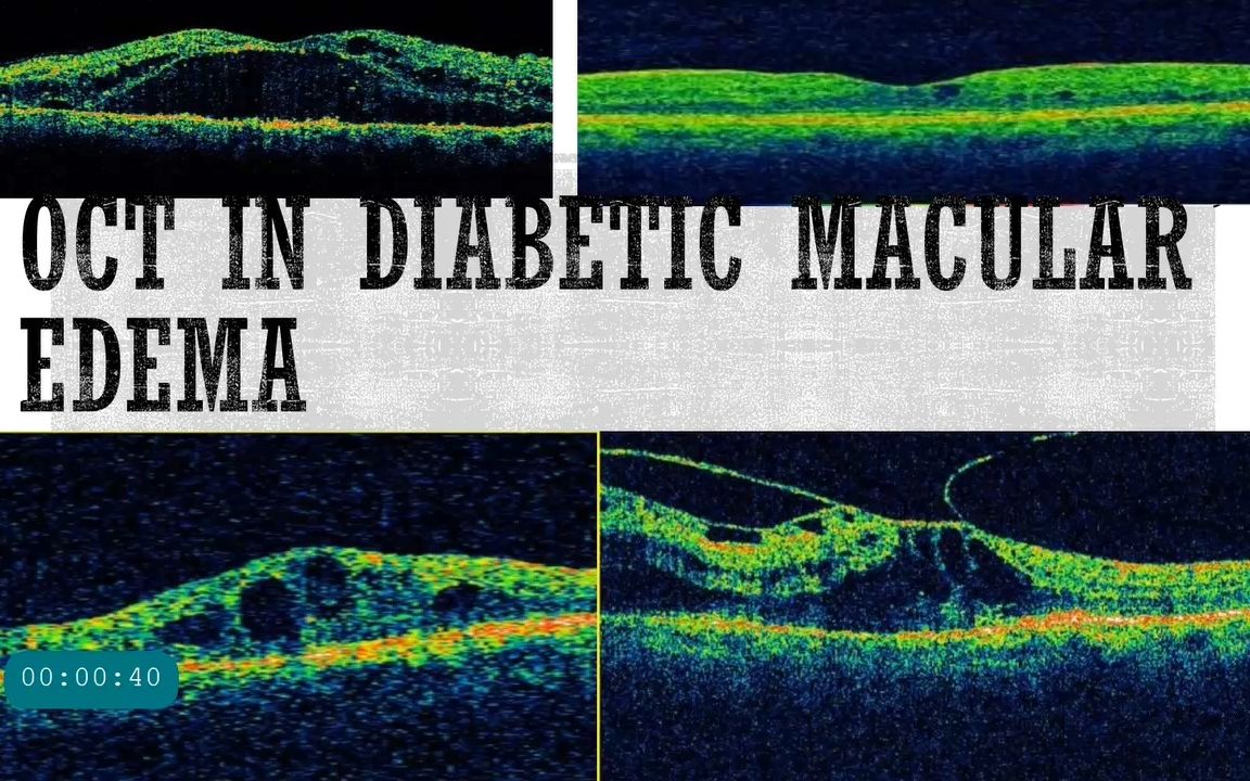 oct in diabetic retinopathy - 糖尿病视网膜病变oct表现