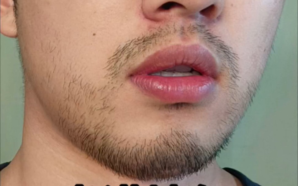 米诺地尔效果展示,你们想留胡子的话,进来留言